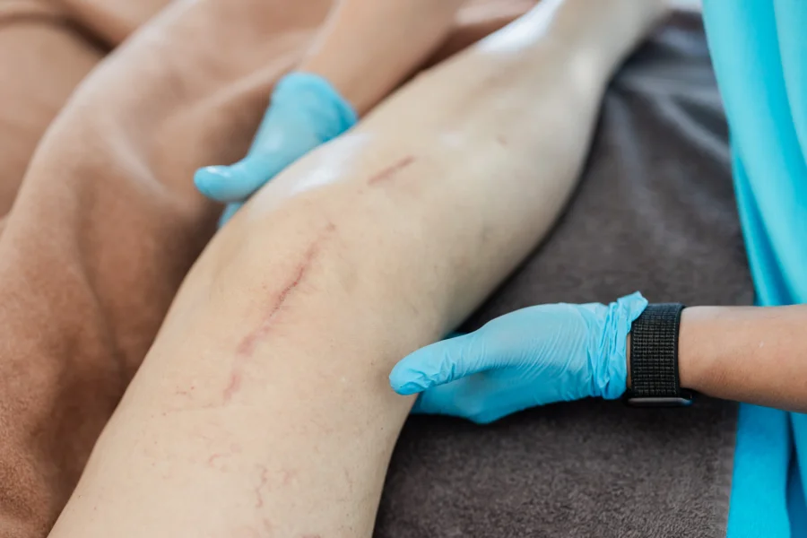 Manuelle Lymphdrainage der unteren Extremität. Postoperativ nach Knie Totalendoprothese (TEP).
Stehende Kreise durch die Kniekehle zur Abschwellung im Kniegelenk und Erweiterung der Beweglichkeit der Kniebeugung.