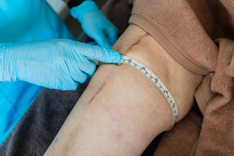 Verlaufskontrolle der Schwellung am Knie nach Totalendoprothese mittels manueller Lymphdrainage – sichtbare Umfangsmessung mit Maßband.