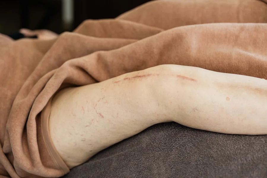 Postoperative Schwellung und Narben am Bein nach Knie-Operation (Knie-TEP) – Anwendung der manuellen Lymphdrainage zur Entstauung und Unterstützung der Heilung